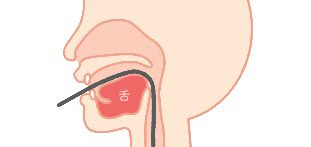 口からの場合（経口内視鏡）